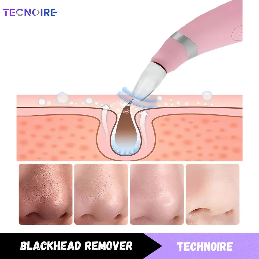 Black Head Remover