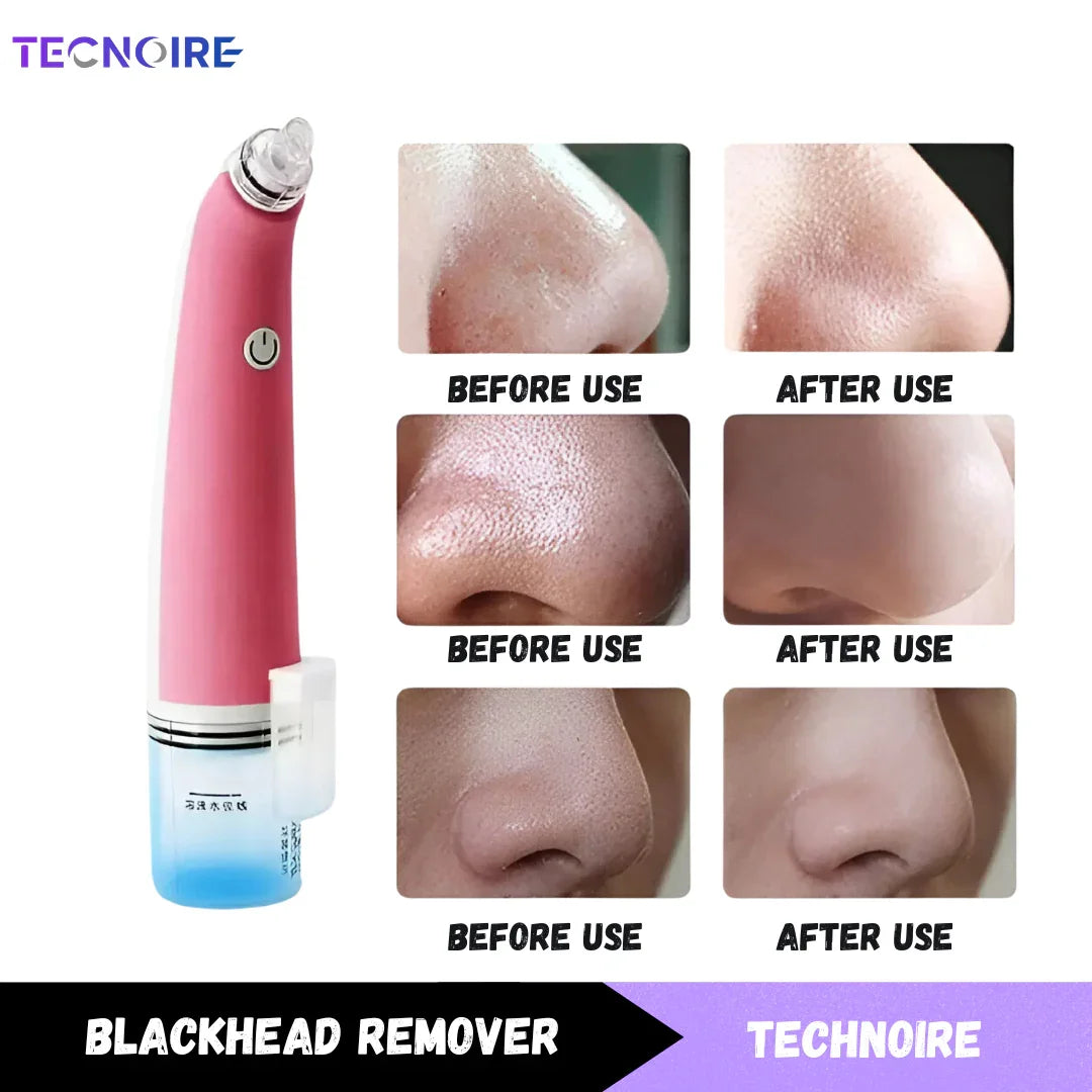 Black Head Remover